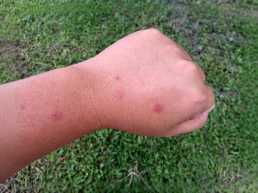 hand hives