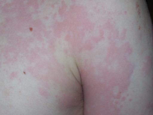 hives rash