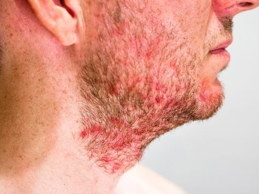 severe hives