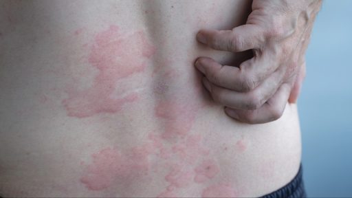skin hives