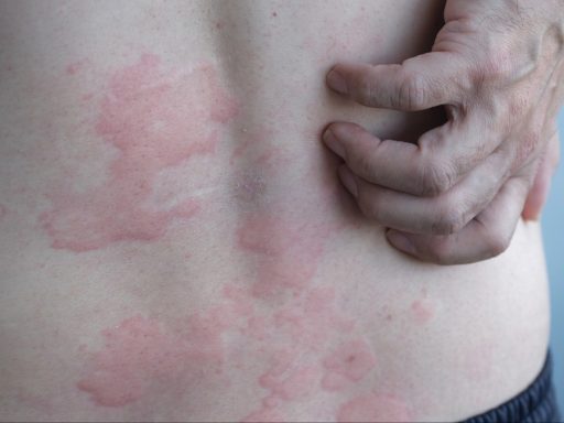skin hives