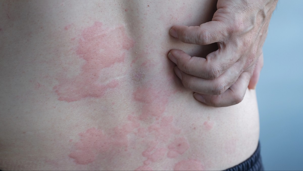 skin hives