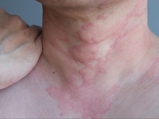 hives on neck