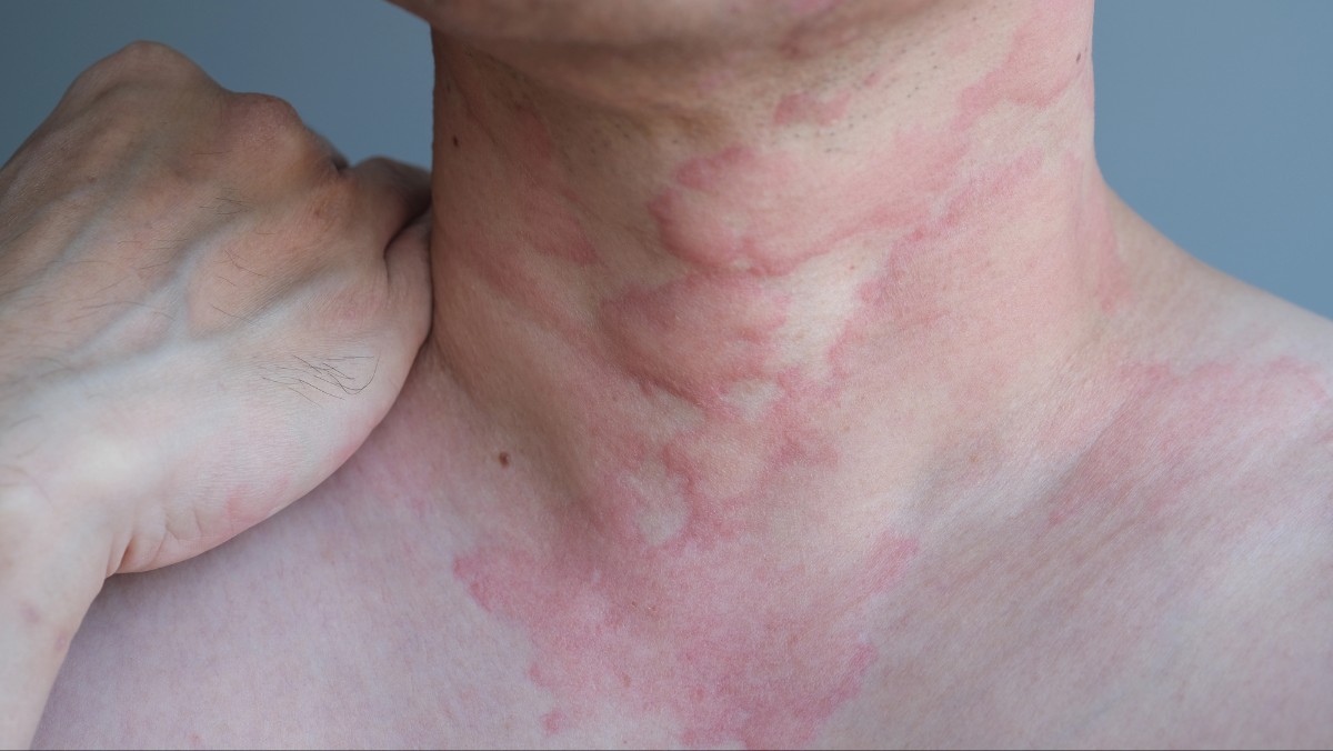 hives on neck